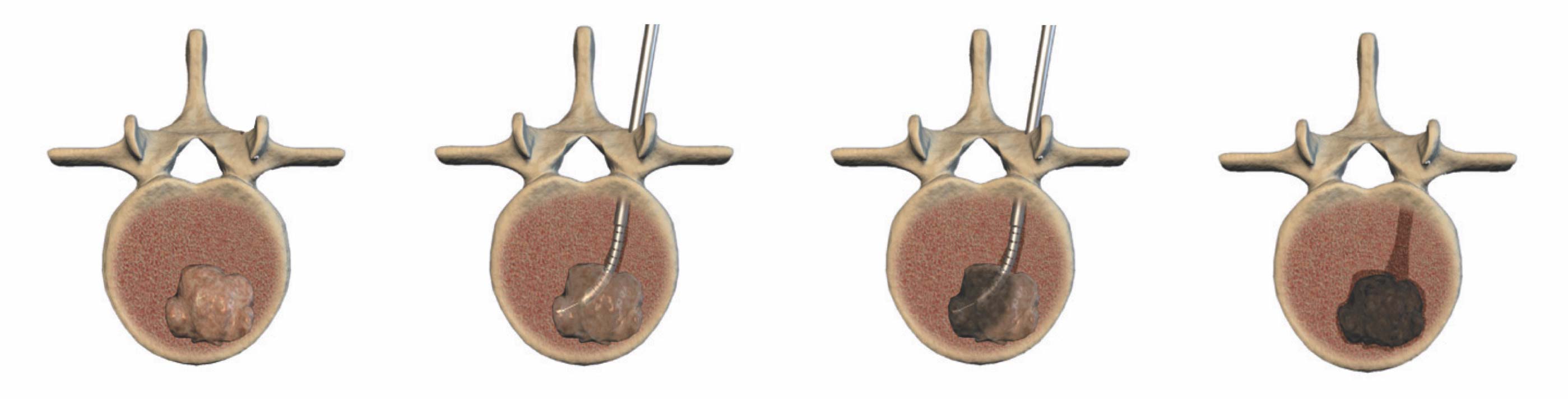 Kyphoplasty