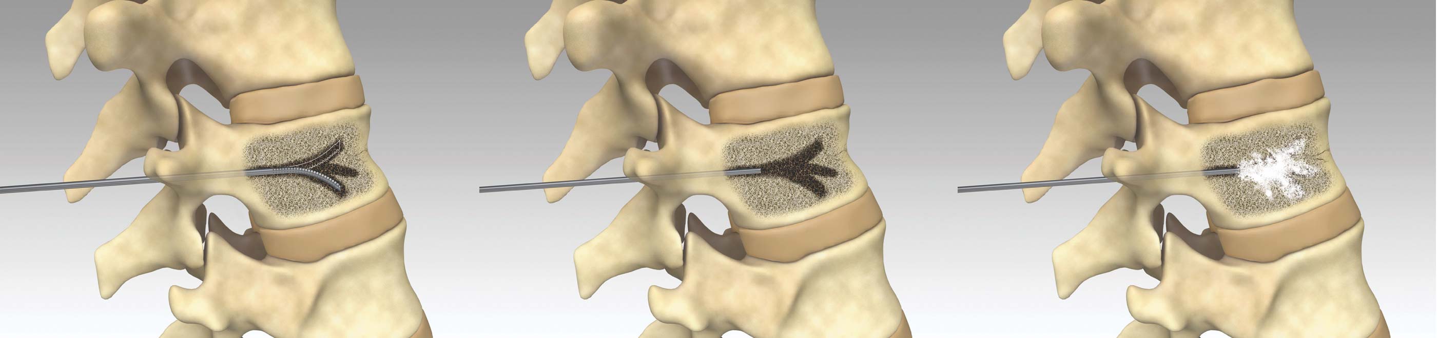 Vertebra Kyphoplasty